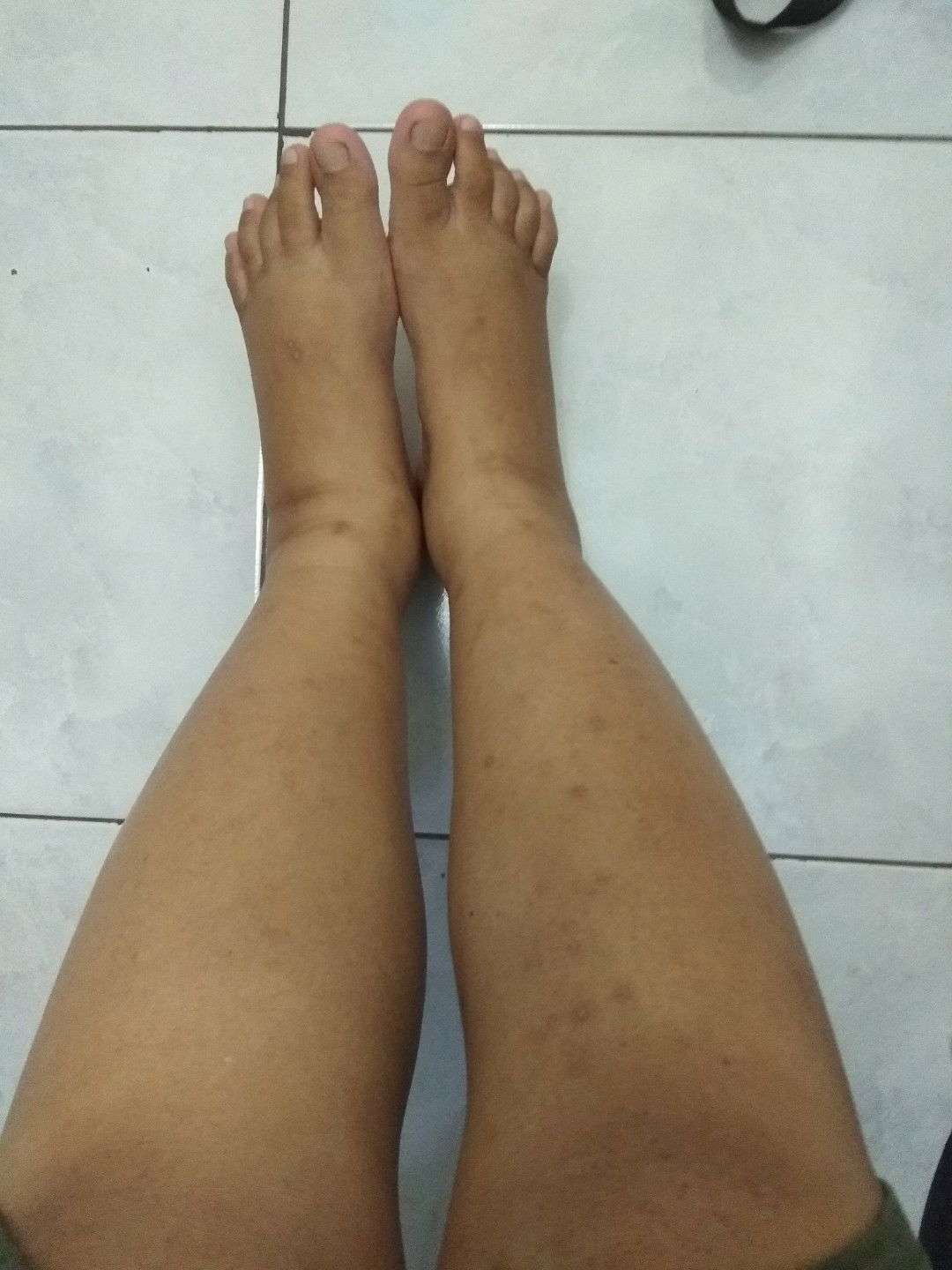 kaki bengkak pasca melahirkan