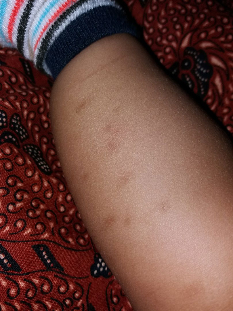 bekas gigitan nyamuk menghitam