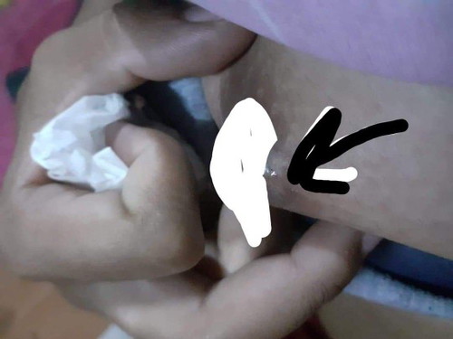 มีอาการตุ่มคันขึ้นตามนม เหมือนผื่น มันลามด้วยค่ะ
