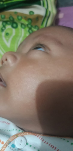 bun mau tanya di pipi kiri anakku ada bercak putih padahal aku gak menyusui asi karna asi aku gak keluar, kta orang jaman dulu katanya klo bercak putih krn asi, makasih