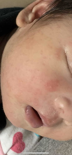 Baby acne ?