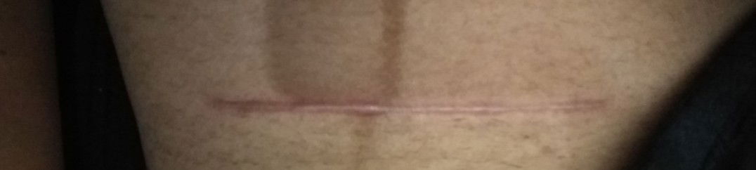 Bekas operasi caesar perih dan panas