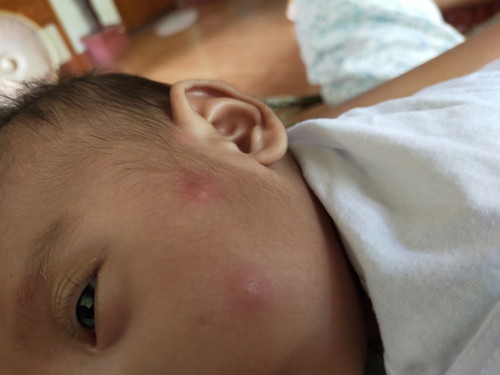 ant bite
