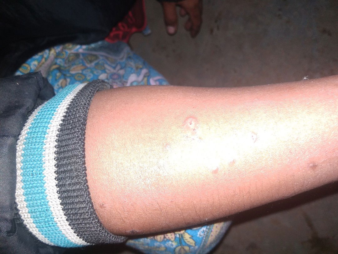 bunda buat ngilangin bekas gigitan seranga ap ya buk ini sampe flek Hitam di perut ak dan tangan