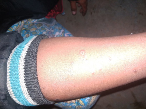 bunda buat ngilangin bekas gigitan seranga ap ya buk ini sampe flek Hitam di perut ak dan tangan
