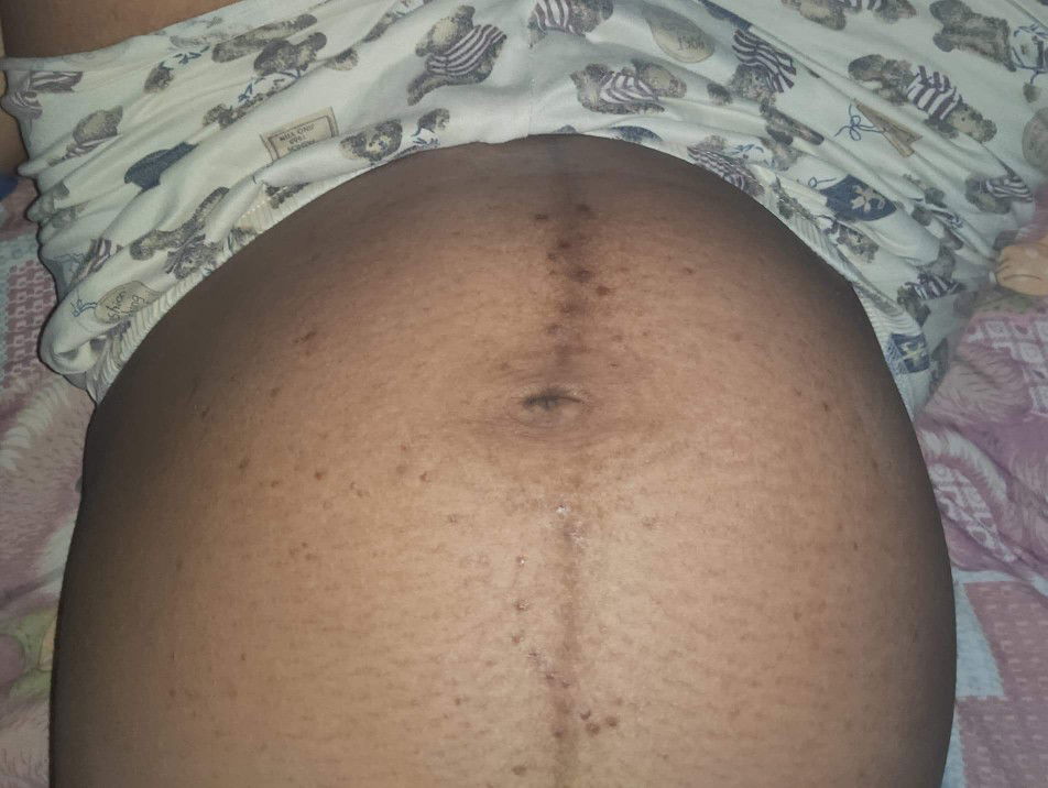 ท้องลาย