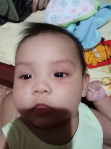 red spot on baby's face