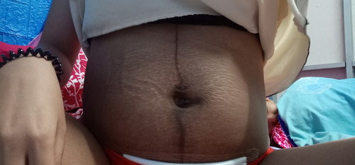 หลังผ่าคลอด