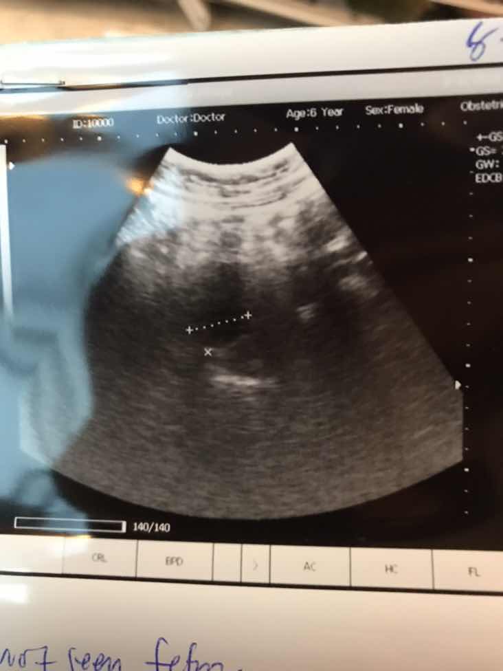 หลังจากเจอภาวะแท้งคุกคาม ?