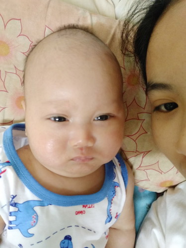 ผื่นร้อน