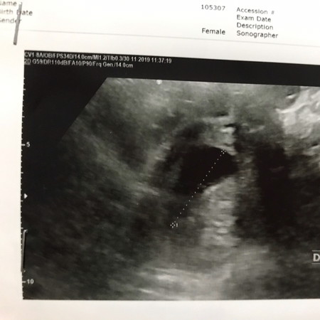 พบตัวอ่อนช้าสุดกี่สัปดาห์กันคะ บ้านนี้ 8 สัปดาห์แล้วเจอแต่ถุงค่ะ ??