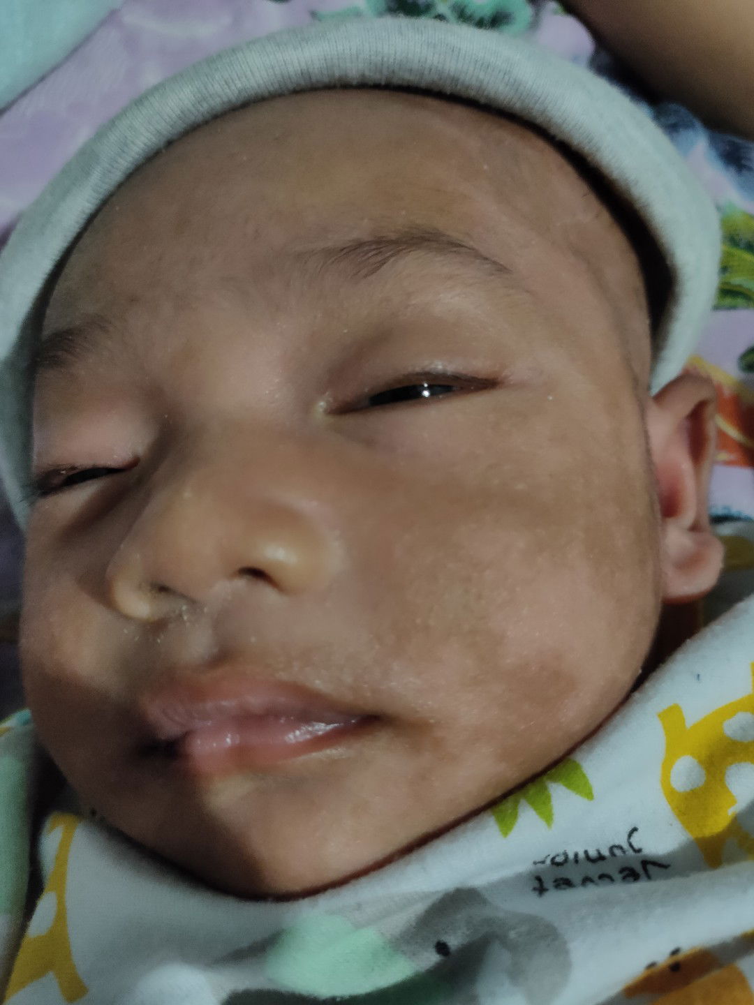 bercak putih seperti panu