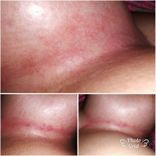 Underboobs Rashes