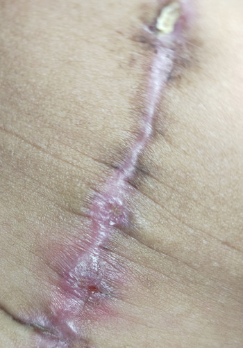 Cesarean Scar.