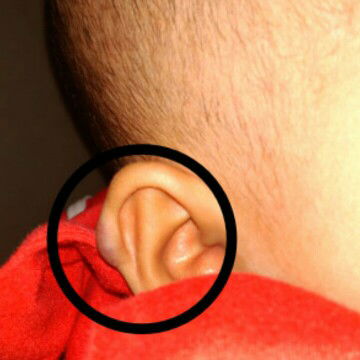 kemerahan yang ada di telinga bayi