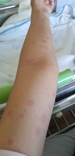 rashes after birth