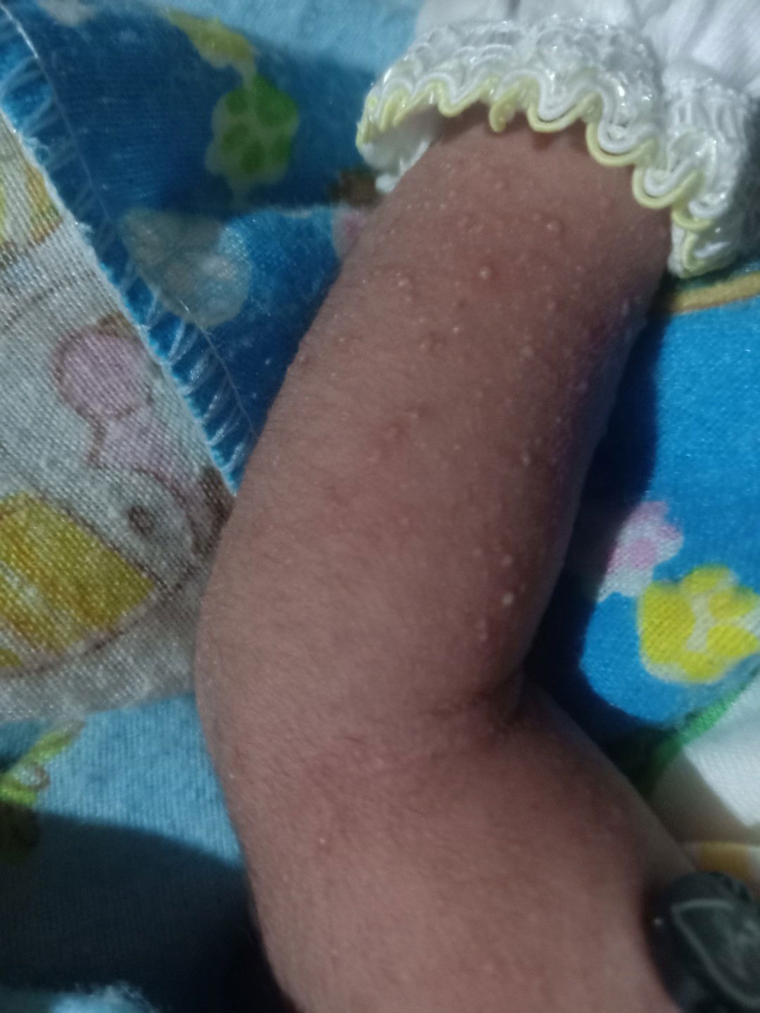 Bintik bintik di tangan bayi