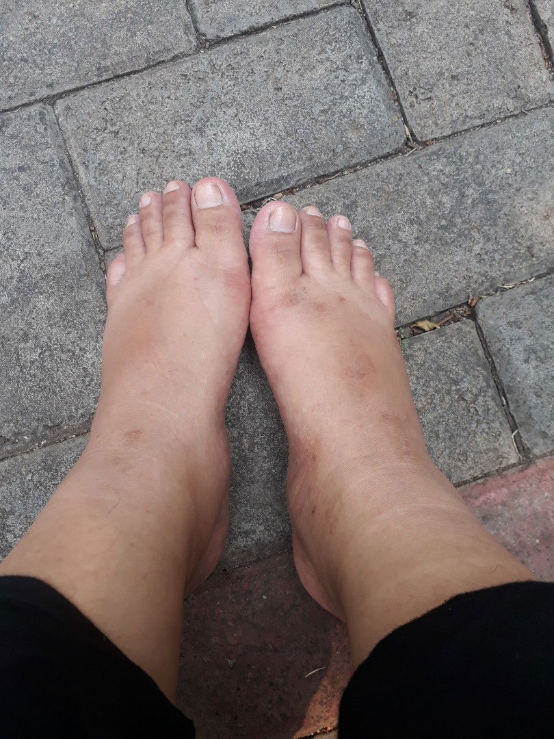 normal kah kalau sedang hamil kaki bengkak