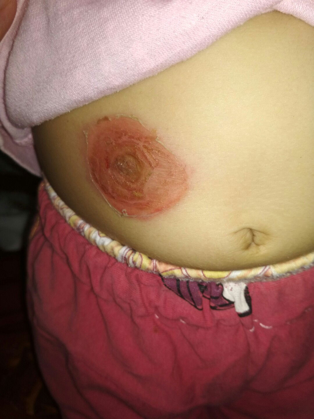 luka hanya bintik merah jadi melebar seperti luka bakar