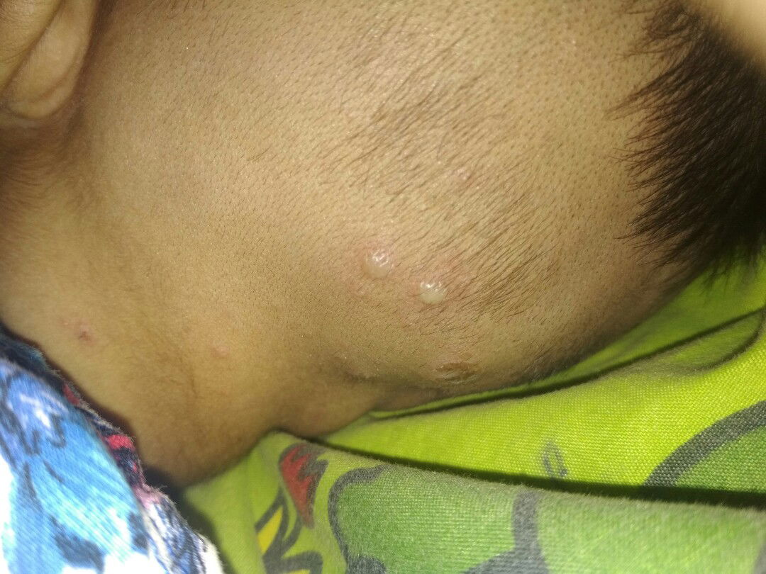 muncul bulet kecil di kepala belakang