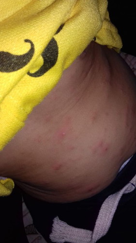 kulit bayi beruntusan