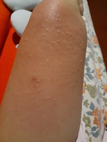 Rashes after giving birth