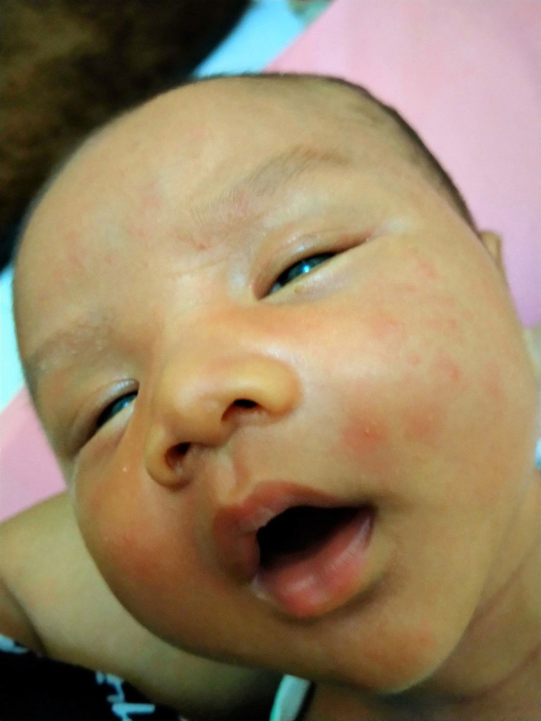 ruam merah di wajah bayi