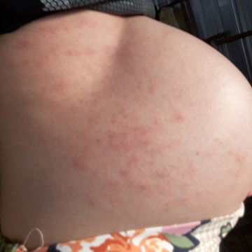 เป็นผื่นคันค่ะ