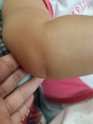 Rashes...