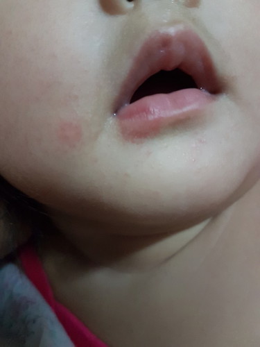 rashes?