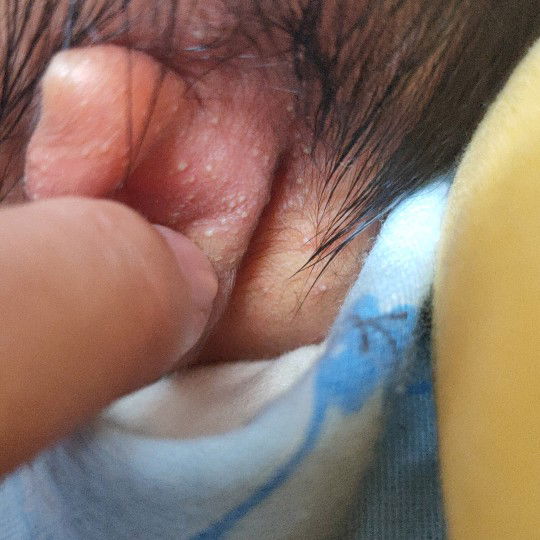 kulit bayi kemerahan