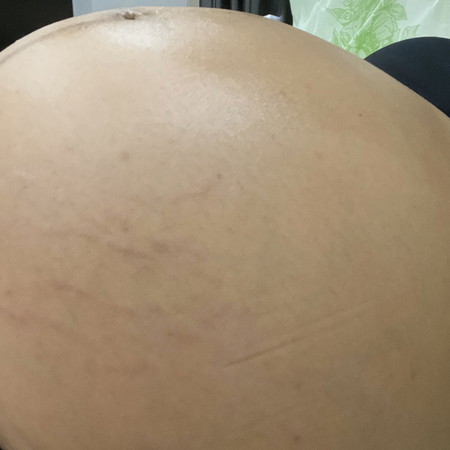 ช่วยด้วยท้องลาย