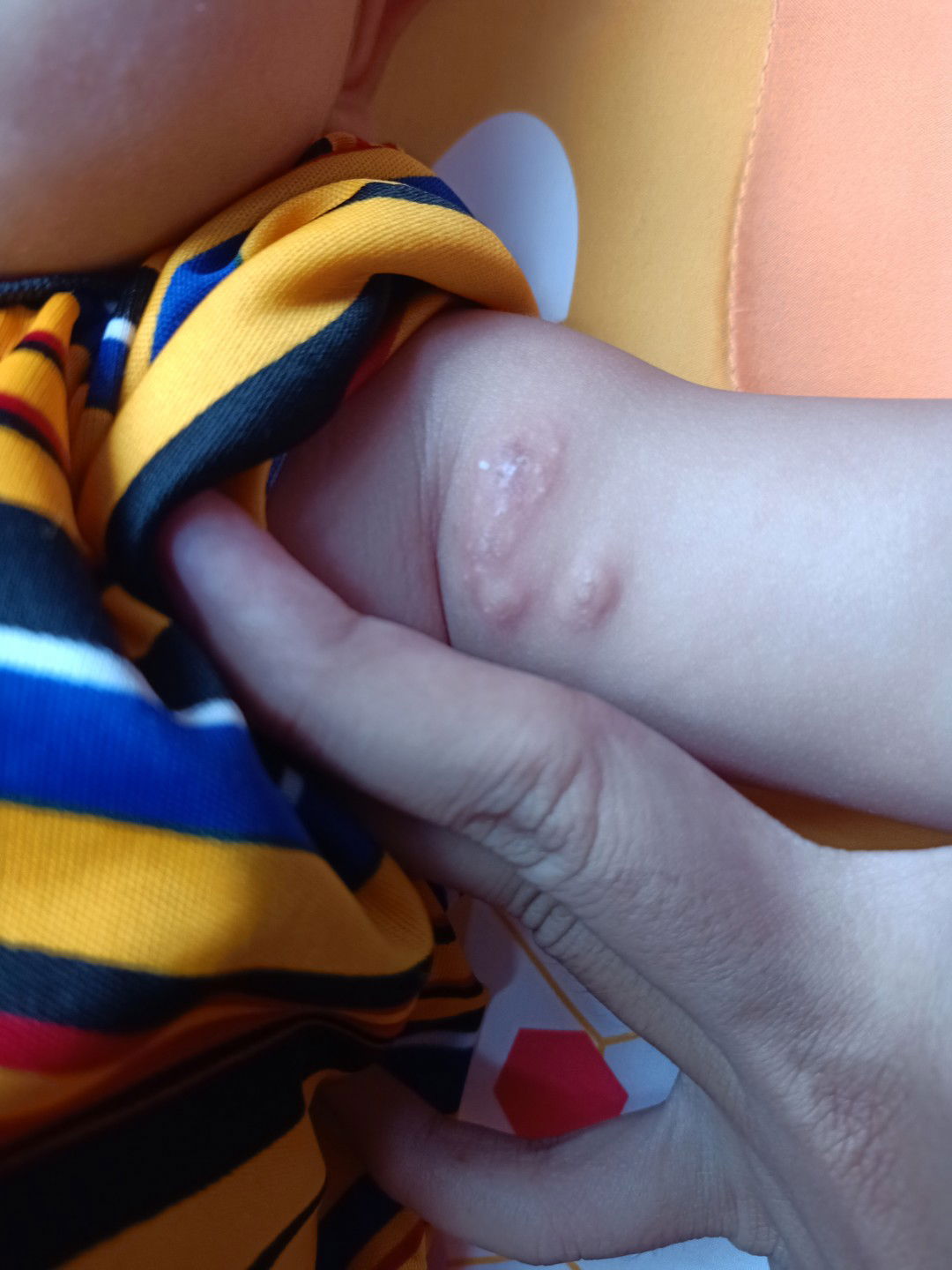 bentol semakin banyak