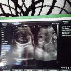 baby 25 week