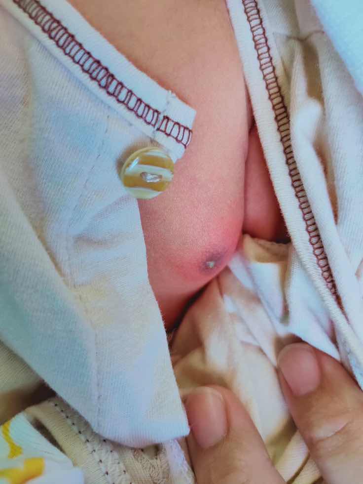 ตุ่ม หนอง