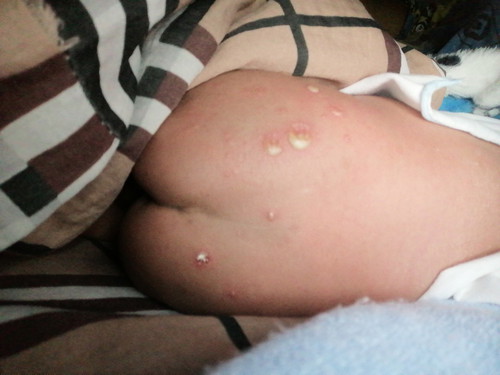 อยากสอบถามคนที่รู้หรือแม่ๆที่มีลูกน้อยเคยเป็น