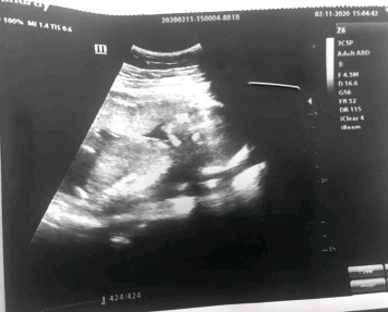 18.4 weeks ULTRASOUND!