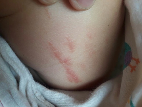 ตุ่มขึ้นค่ะ