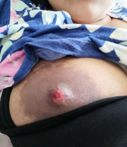 Nipple Sore