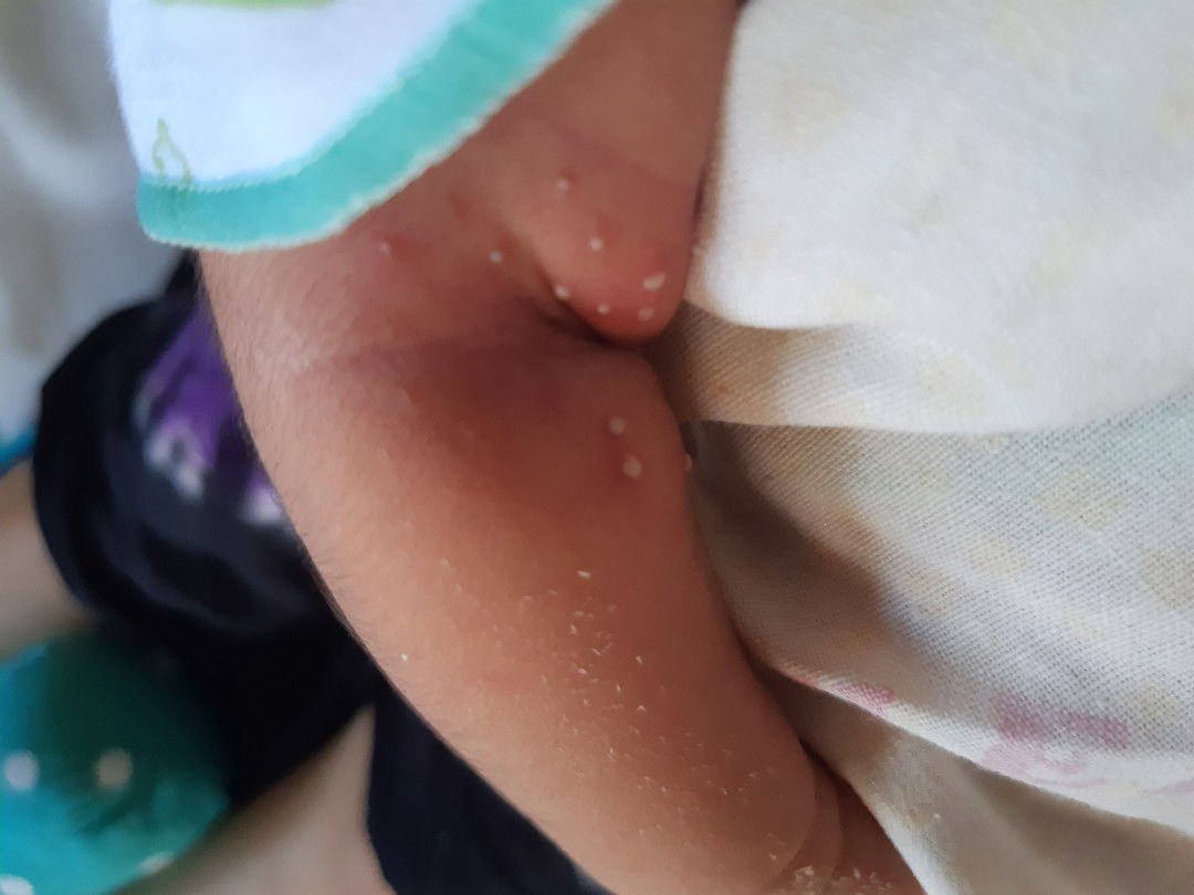 bintik2 putih pada bayi