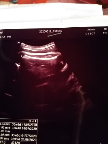 อายุครรภ์36วีค