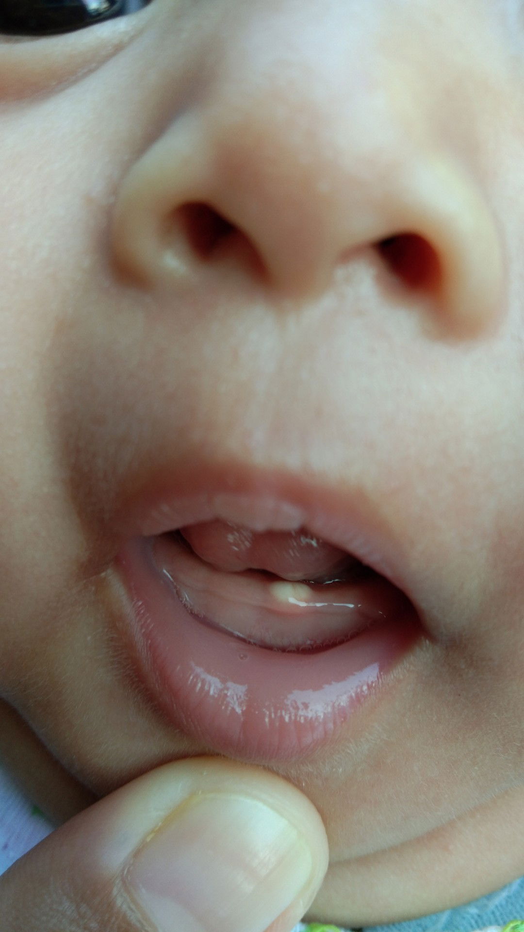 gusi membesar berwarna putih