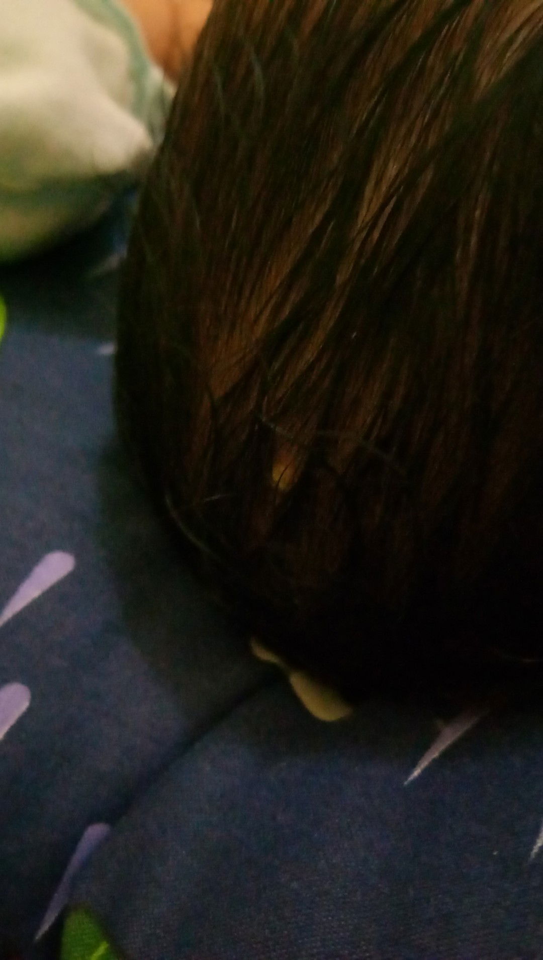 Bintil putih/ bisul kecil