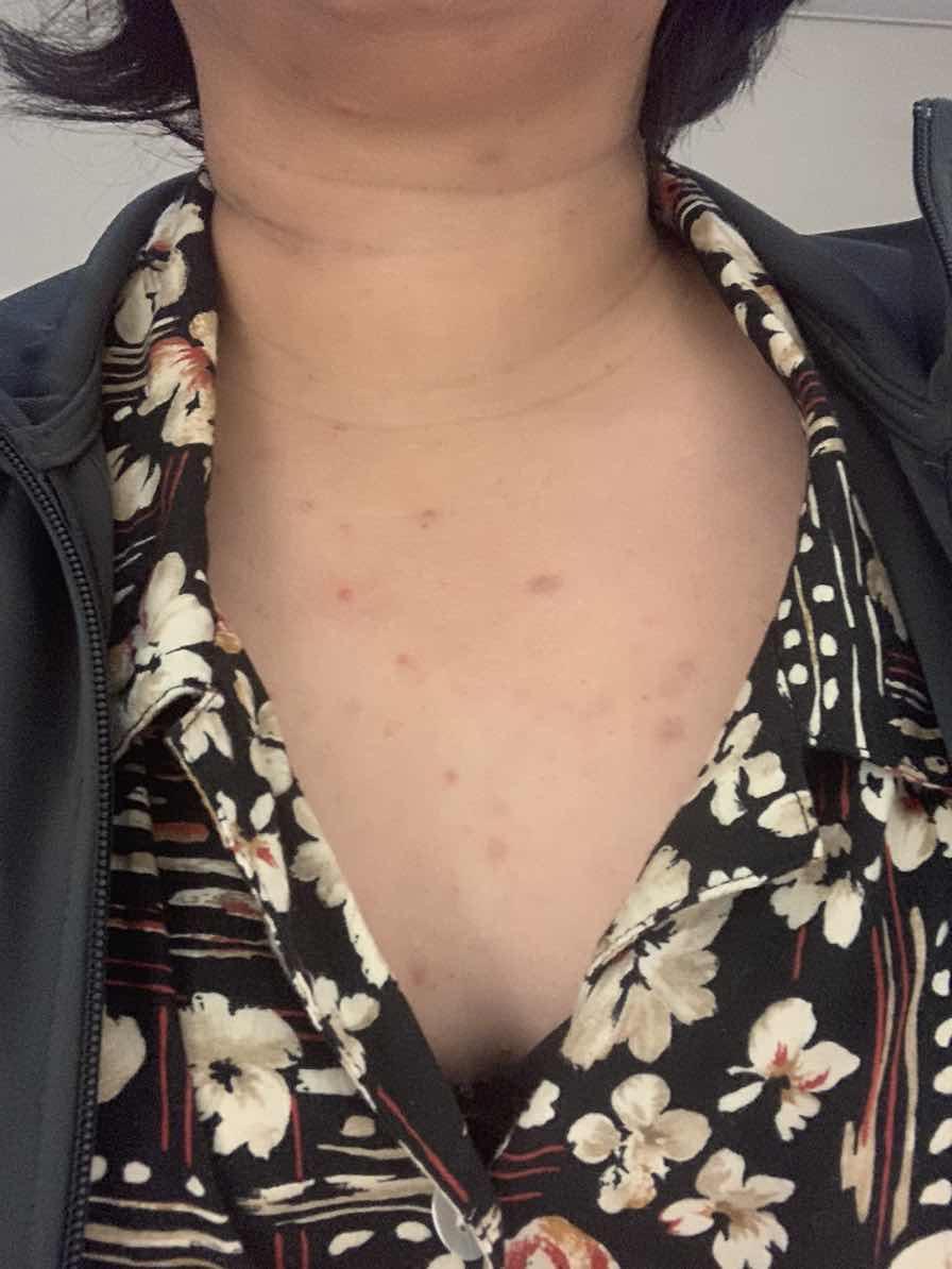 สิวขึ้น