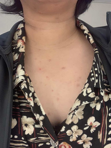 สิวขึ้น