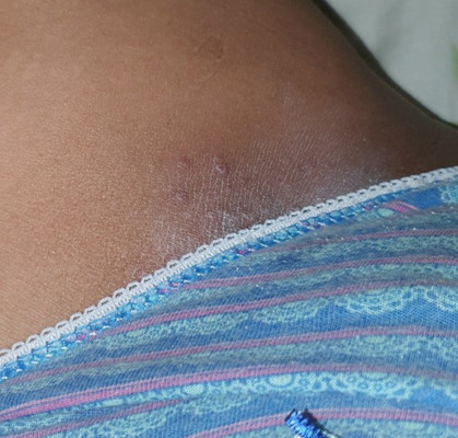 Rashes, normal po ba?