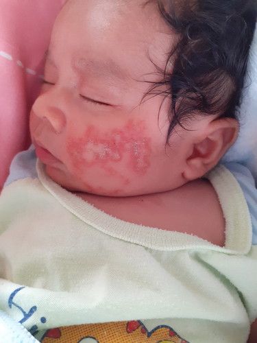 ลูกบ้านไหนเคยมีอาการแพ้แบบนี้บ้างค่ะตอนนั้นที่แพ้1เดือน10วันแต่ตอนนี้หายปกติแล้วค่ะเอาประสบการณ์มาแชร์กันได้นะเพื่อคุณแม่มือใหม่ค่ะ