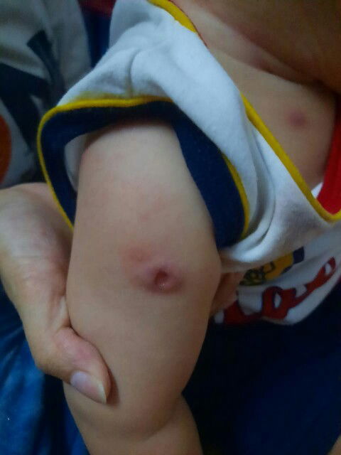 Bekas vaksin bcg pecah smp bolong