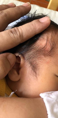 Pa help nmn ano po kaya tung nasa ulo ni baby magkabilaan po kcing merong xang gnyan sa side ng ulo nyahh rashes po ba ito Mga momsh
