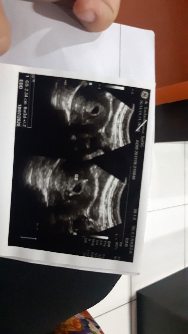 flex dan usia kandungan tidak sesuai saat usg